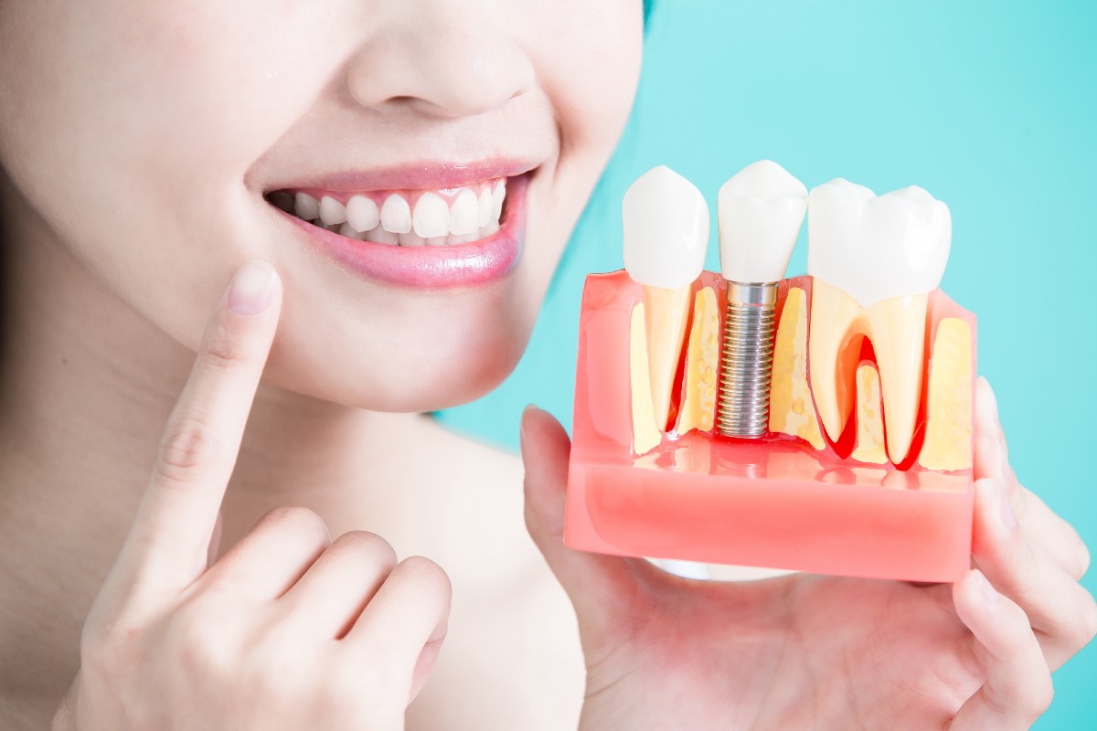 Имплантация зубов под ключ - описание процедуры, особенности
