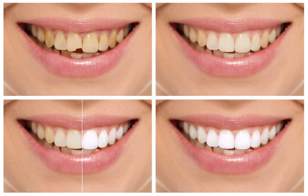 Виниры и реставрация зубов до и после