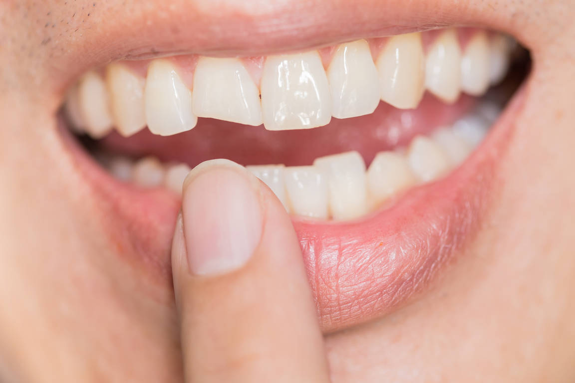 Как делают наращивание передних зубов?