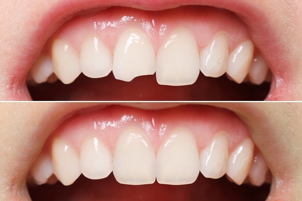 Как происходит наращивание передних зубов?