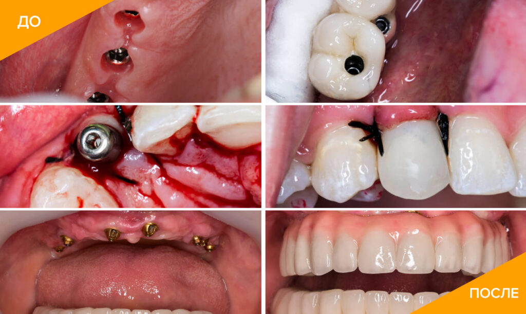 Фото до и после имплантации зубов
