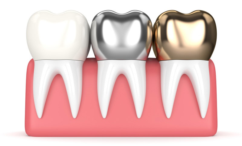 Какие бывают коронки на зубы?