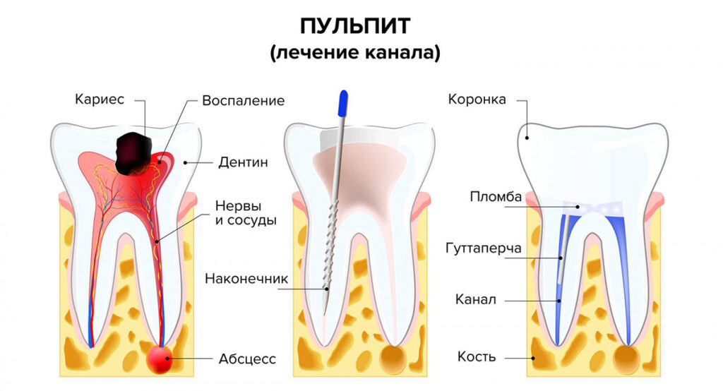 Боль при пульпите и кариесе зубов