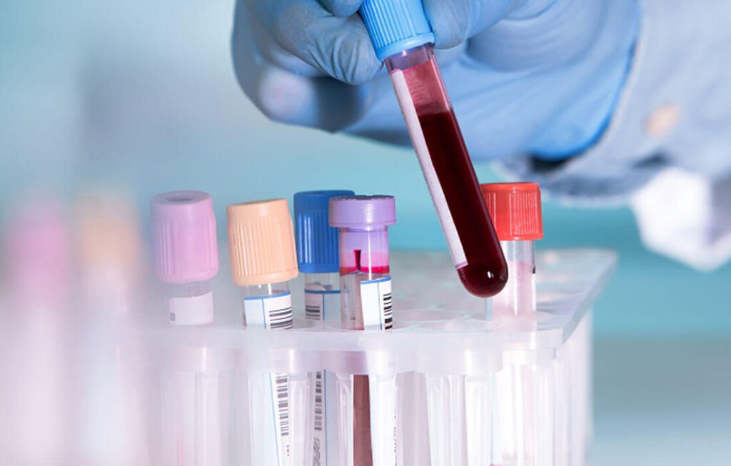 Лабораторное исследование венозной крови