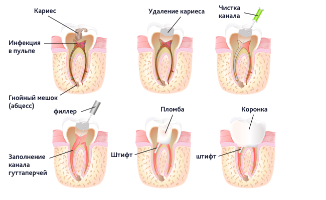 Необходимо ли применение микроскопа при лечении каналов зуба