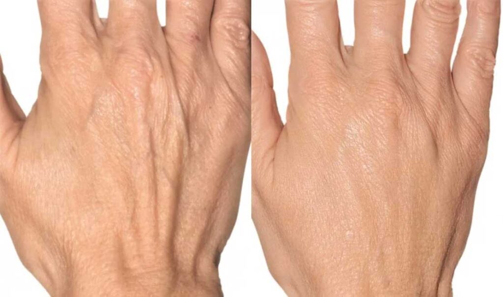 Омоложение рук: фото до и после