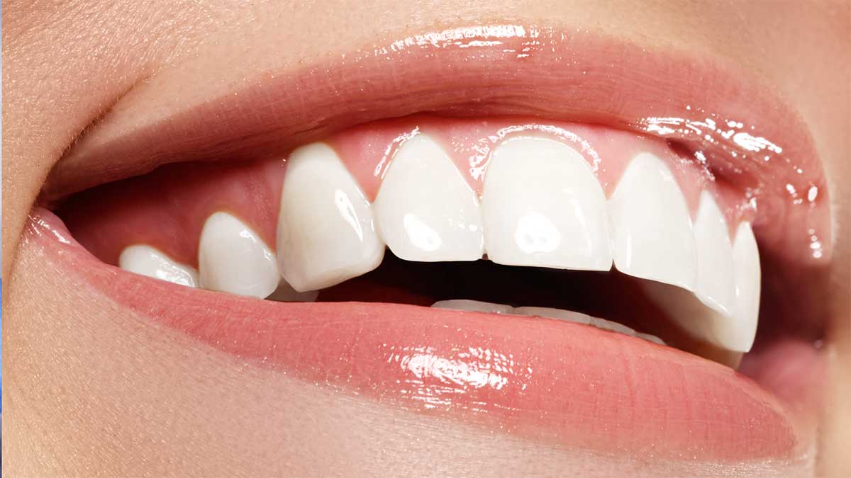 Отбеливание зубов: преимущества и недостатки различных видов