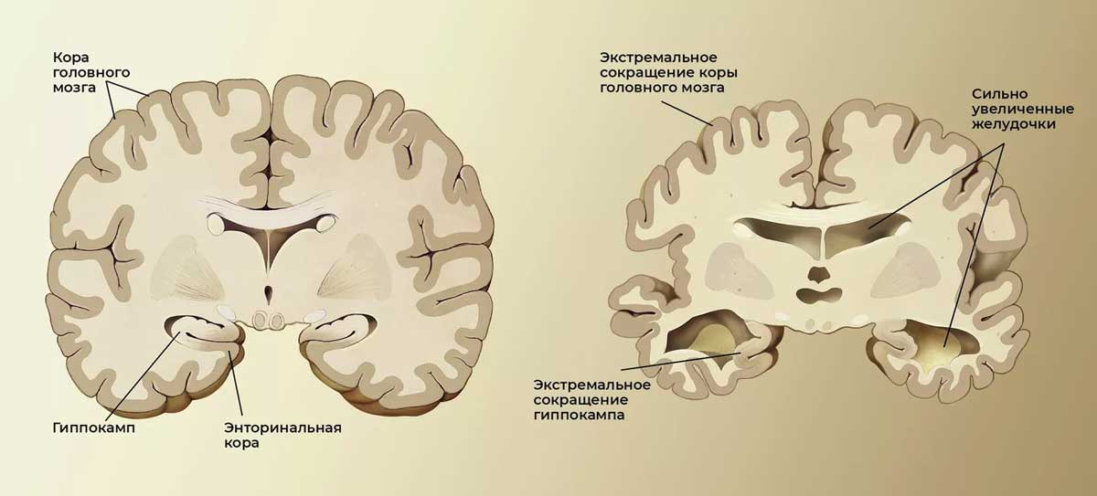 Мозг здорового пожилого человека (слева) и пациента с болезнью Альцгеймера (справа).